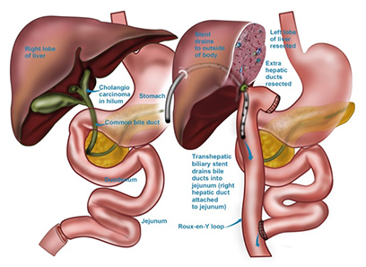 Liver Resection Img