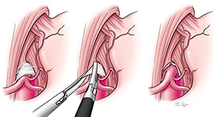 Laparoscopic Median Arcuate Ligament Release Img