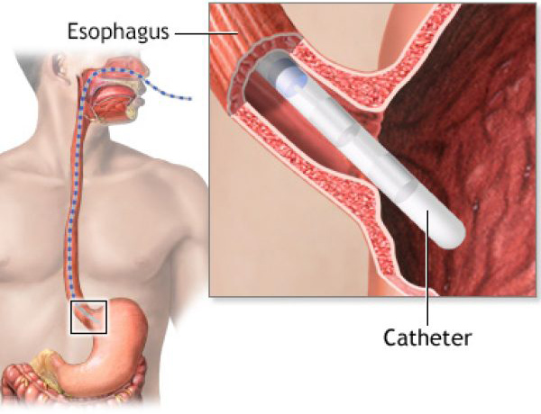 Manometry Achalasia - Educational Photo