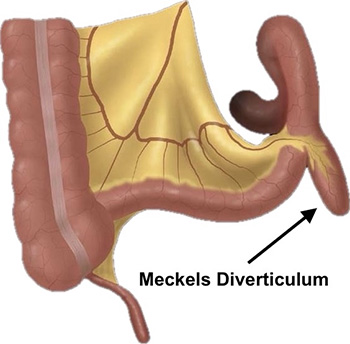 Meckel's Diverticulum