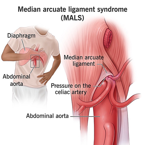 Median Arcuate Ligament Syndrome Img