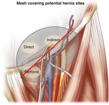 Mesh TEP Image