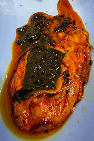Pigment stones Picture1