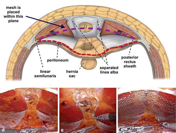 Retrorectus Layer Repair Image