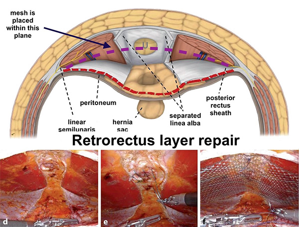 Retrorectus Layer Repair Image