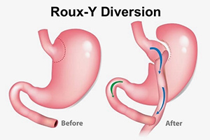 Roux-en-Y Diversion Img