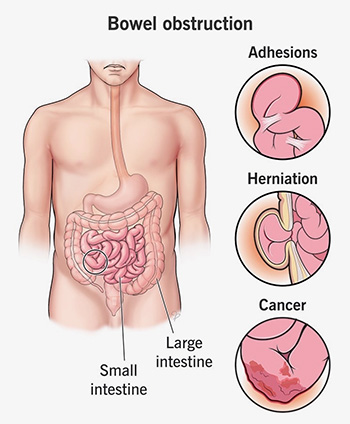 Small Bowel Obstruction