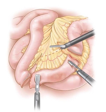 Small Bowel Resection