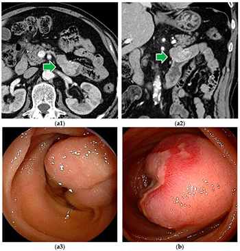 Small Bowel Tumour