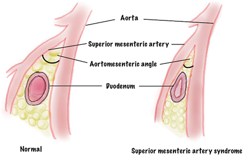 Superior Mesenteric Artery Syndrome Img