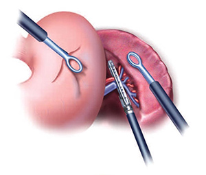 Spelectomy Img