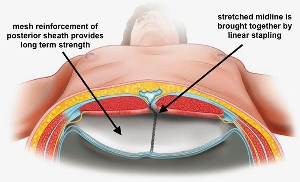 Stapled Retrorectus Image