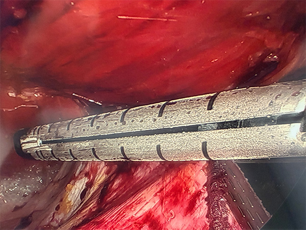 Stapled Retrorectus Image