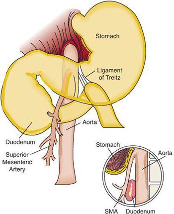 Superior Mesenteric Artery Syndrome Img