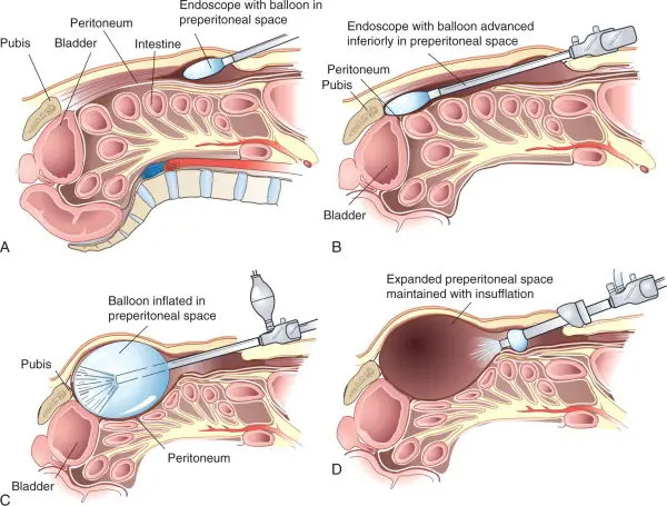 TEP Hernia Image