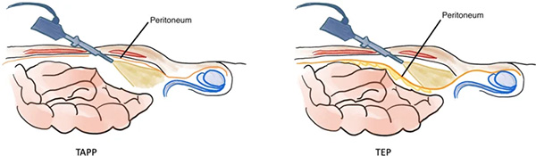 TEP vs TAPP Image