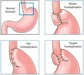 Fundoplication Surgery Img